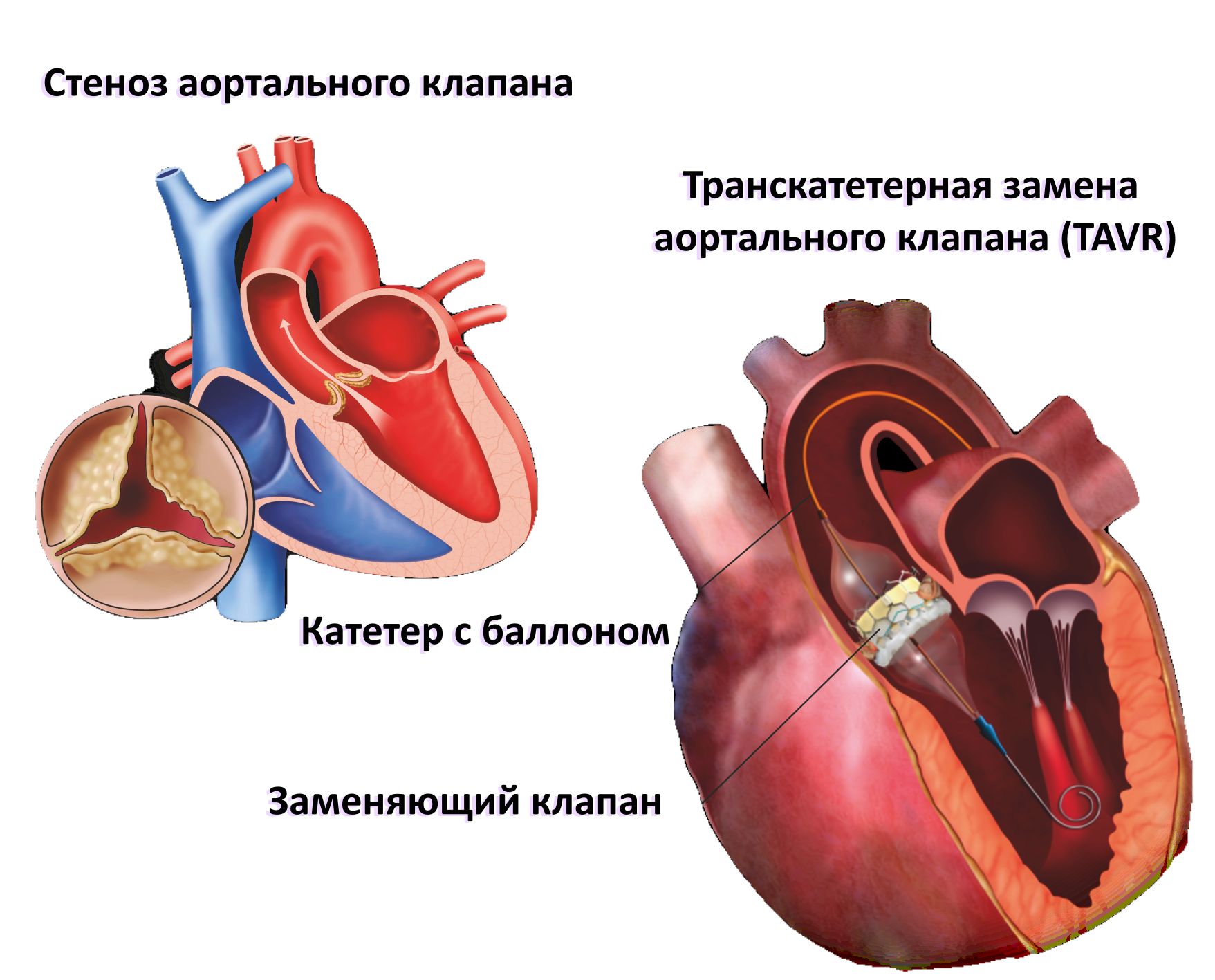 tavr03r