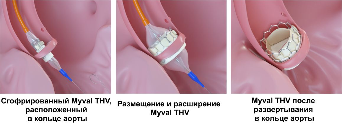 tavr04r bold